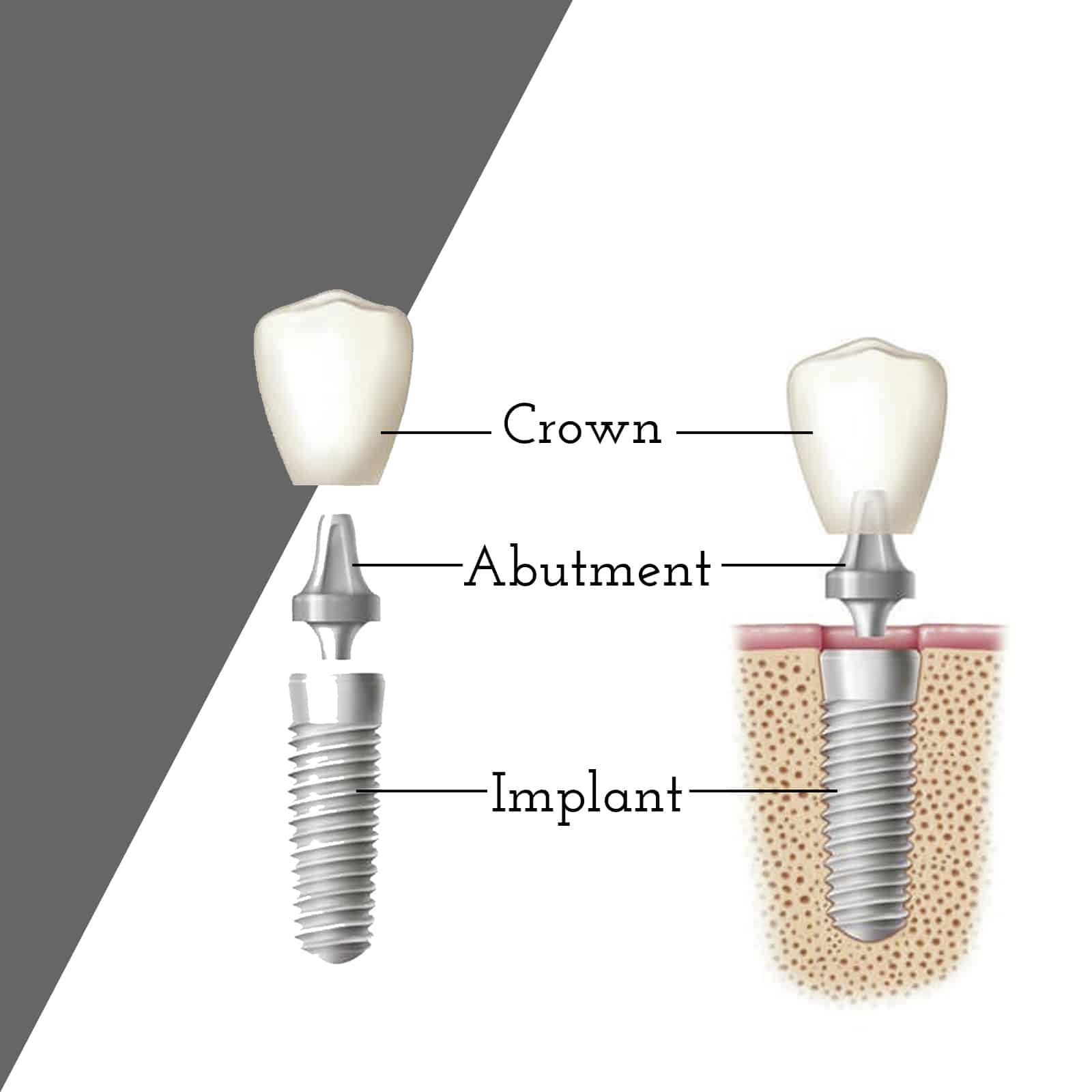 Cranberry Dental Studio | Dental Implants