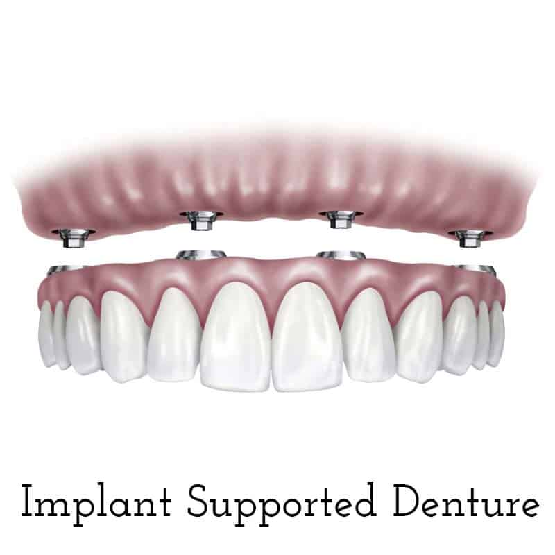 Cranberry Dental Studio | Implant Supported Denture