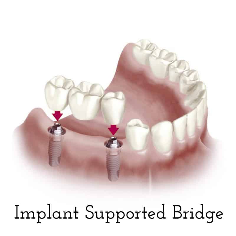 Cranberry Dental Studio | Implant Supported Bridge