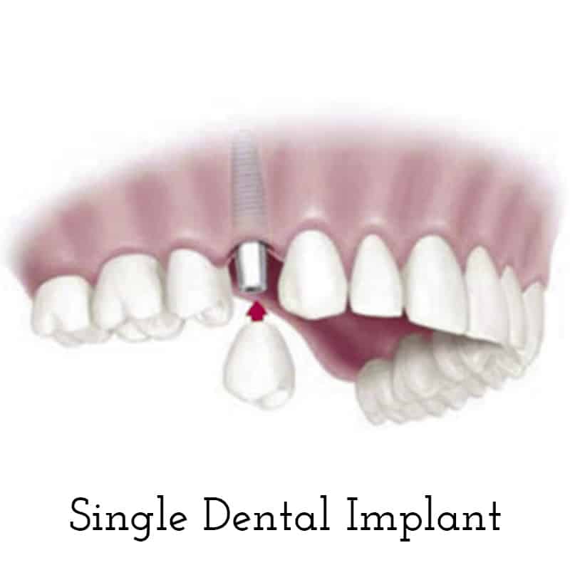 single dental implant
