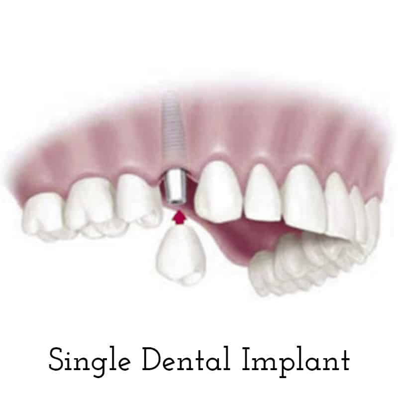 Cranberry Dental Studio | Single Dental Implant