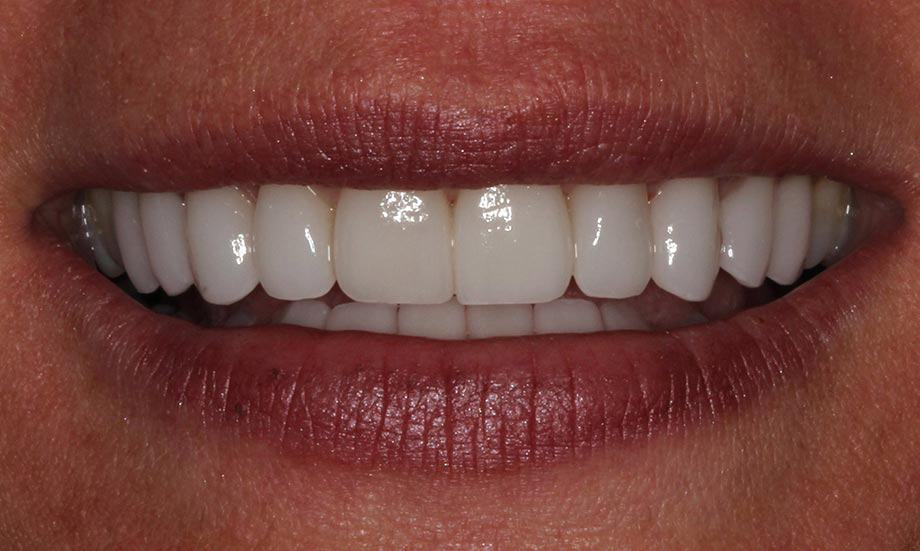 after cranberry dental