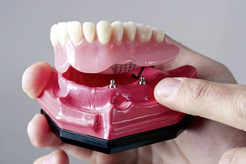 implant denture Cranberry Dental Studio | Implant-Supported Dentures