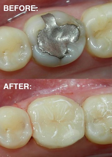 Before and after fillings photos
