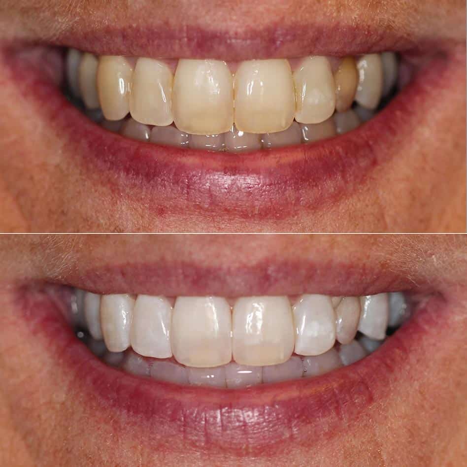 Zoom! InOffice Whitening Cranberry Dental Studio