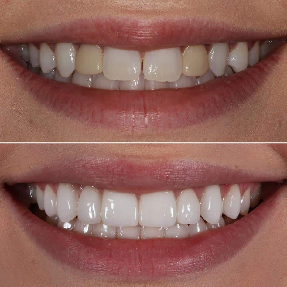 Porcelain Veneers Cranberry Dental Studio