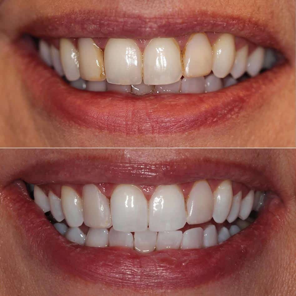 In office zoom whitening lpocut