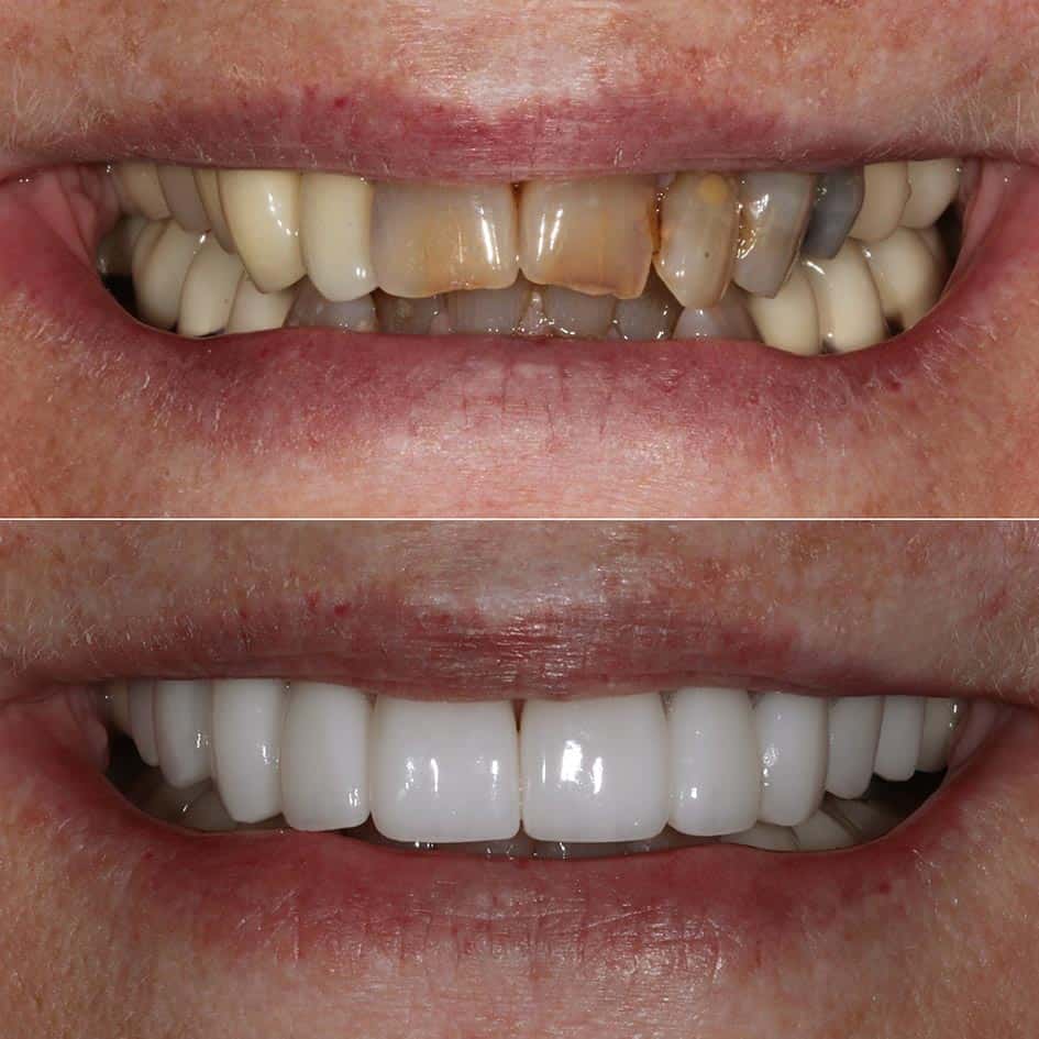 Porcelain Veneers Cranberry Dental Studio