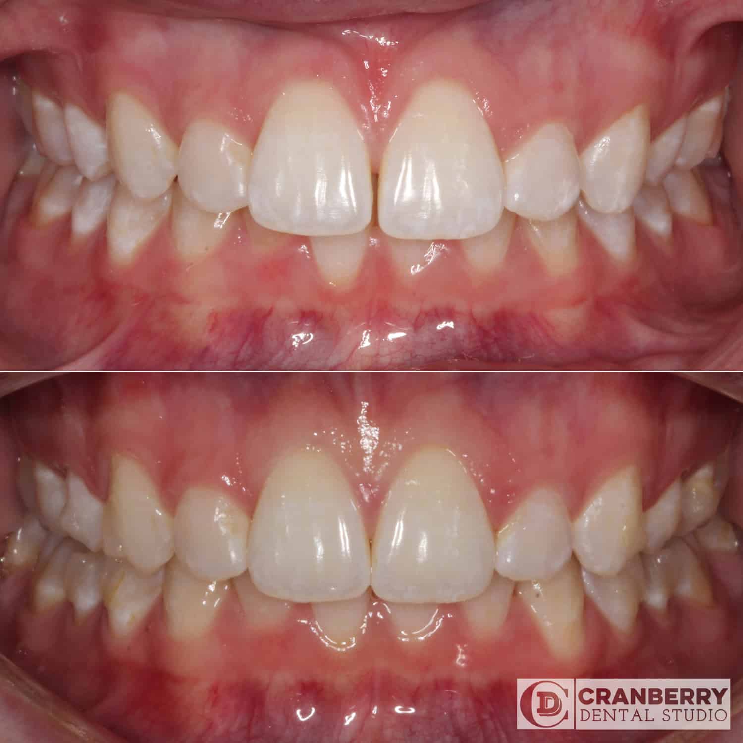 Invisalign treatment before and after by Cranberry Dental Studio