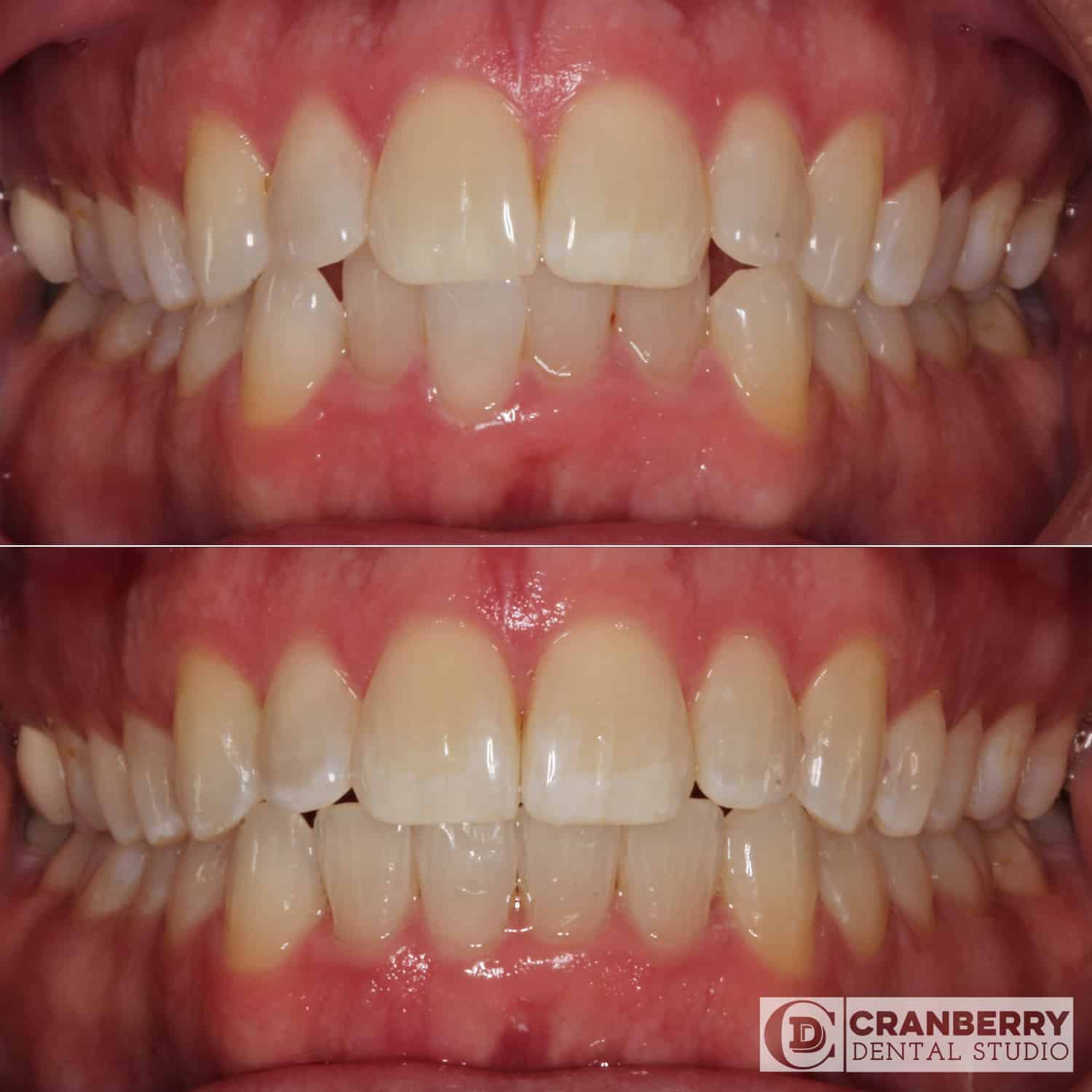 clear aligners before and after by Cranberry Dental Studio