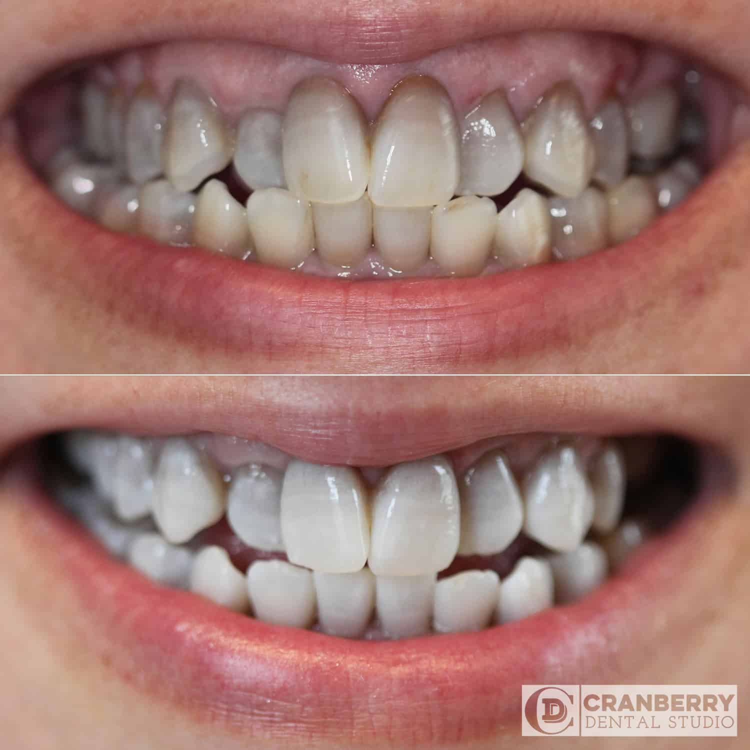whitening before and after treatment picture