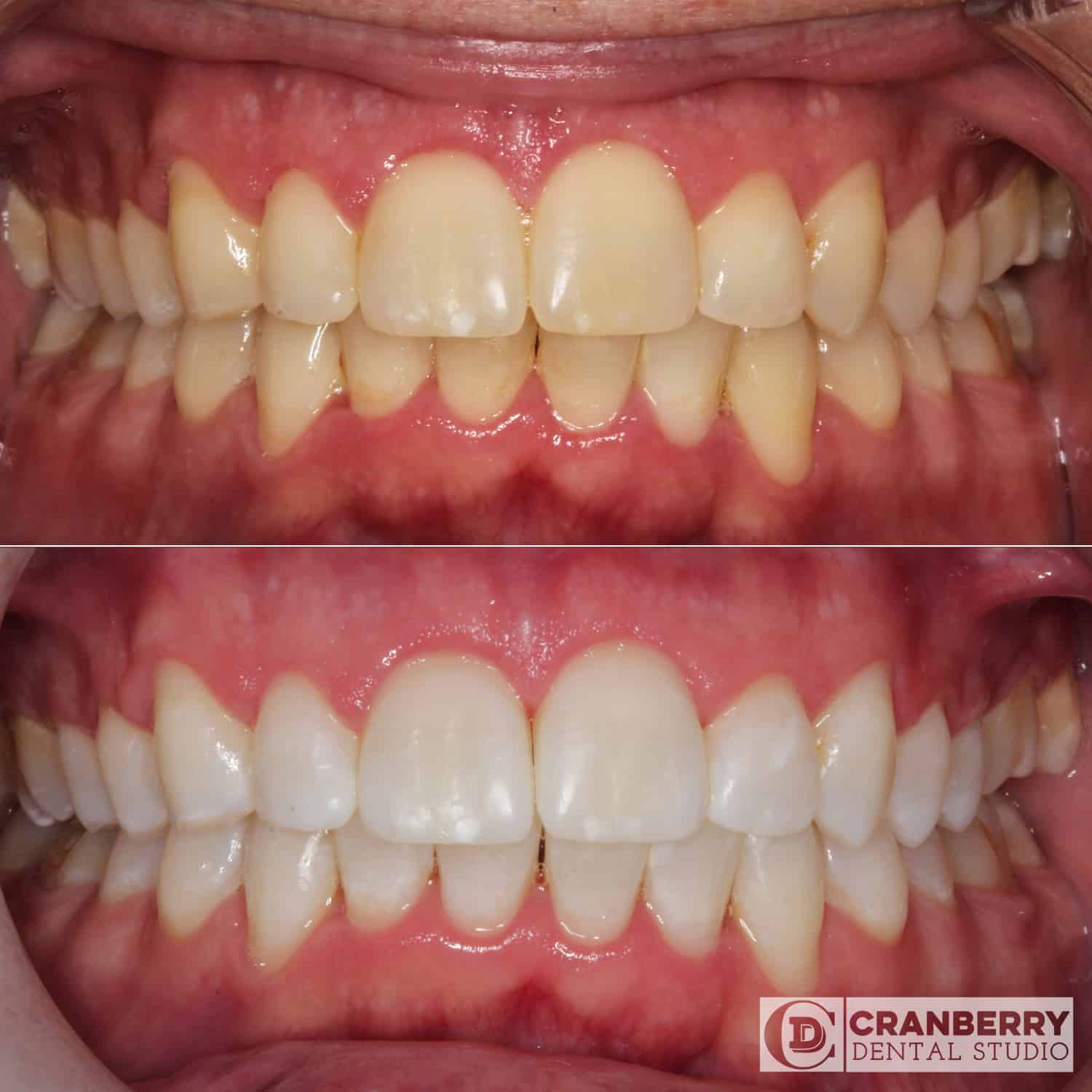 whitening before and after treatment picture