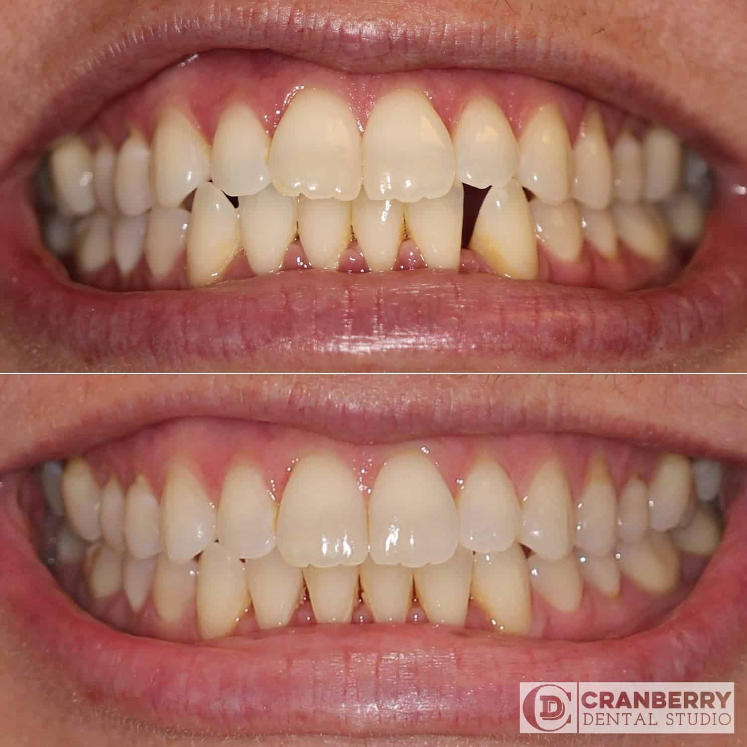 Invisalign before and after by Cranberry Dental Studio