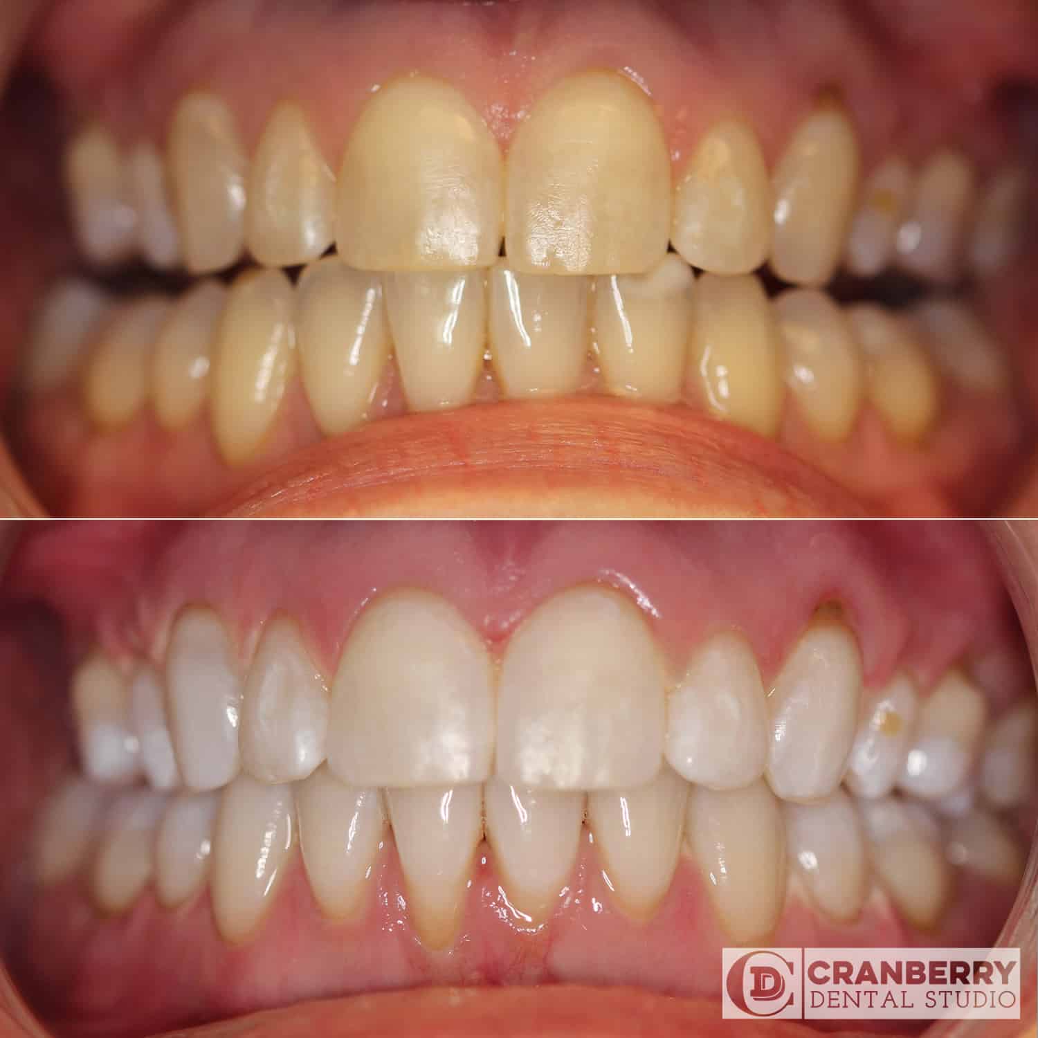 whitening before and after treatment picture