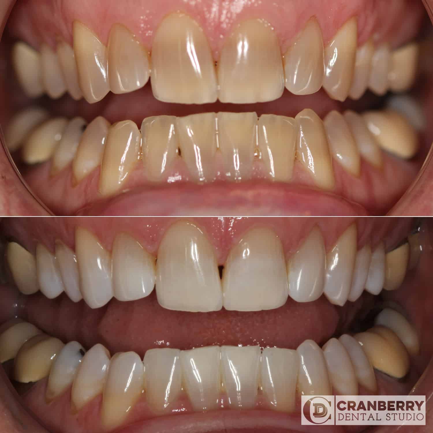 whitening before and after treatment picture
