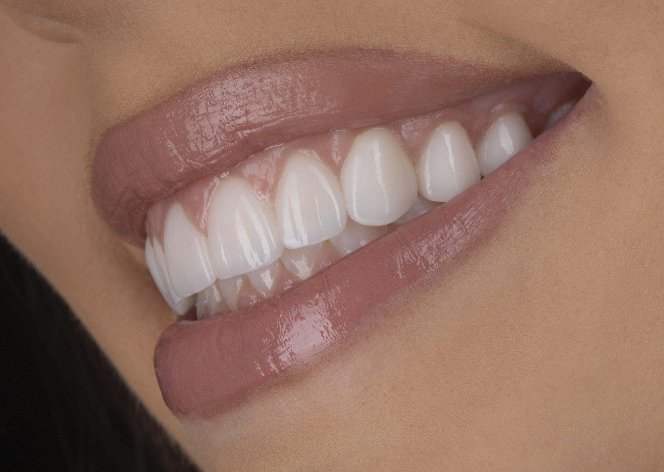 After Side Cranberry Dental Studio | Zoom! Professional Whitening